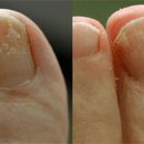 гъбички по ноктите на краката - как да ги разпознаваме