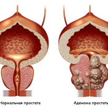 панкреатитът се лекува трудно