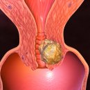 ракът на маточната шийка се лекува, ако забележите навреме тези симптоми