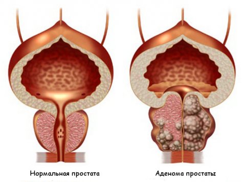 cancer de prostata sintomas