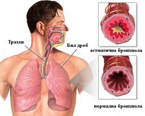 ако имате астма, направете следната важна процедура, за да можете да дишате добре
