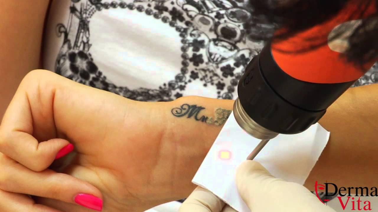 как се премахва татуировка с лазер