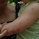 ухапване от комар при детето - съвети за майката