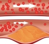 как се лекува атеросклероза
