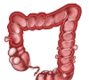 дивертикулоза  поставяне на диагноза