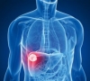 паранеопластични прояви на рака на черния дроб