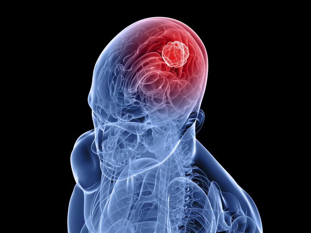 тумор на мозъка-симптоми