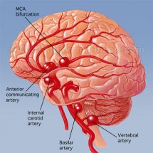 мозъчна аневризма