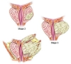 как се лекува ракът на простатата