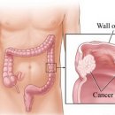 полипи на дебелото черво - рискови фактори за поява