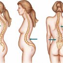 кифоза - изкривяване на гръбначния стълб - ето как да избегнете-