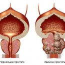 симптоми на простатит и видове