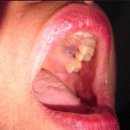 оралният с*кс - сред най-честите причинители на рака на устната кухина