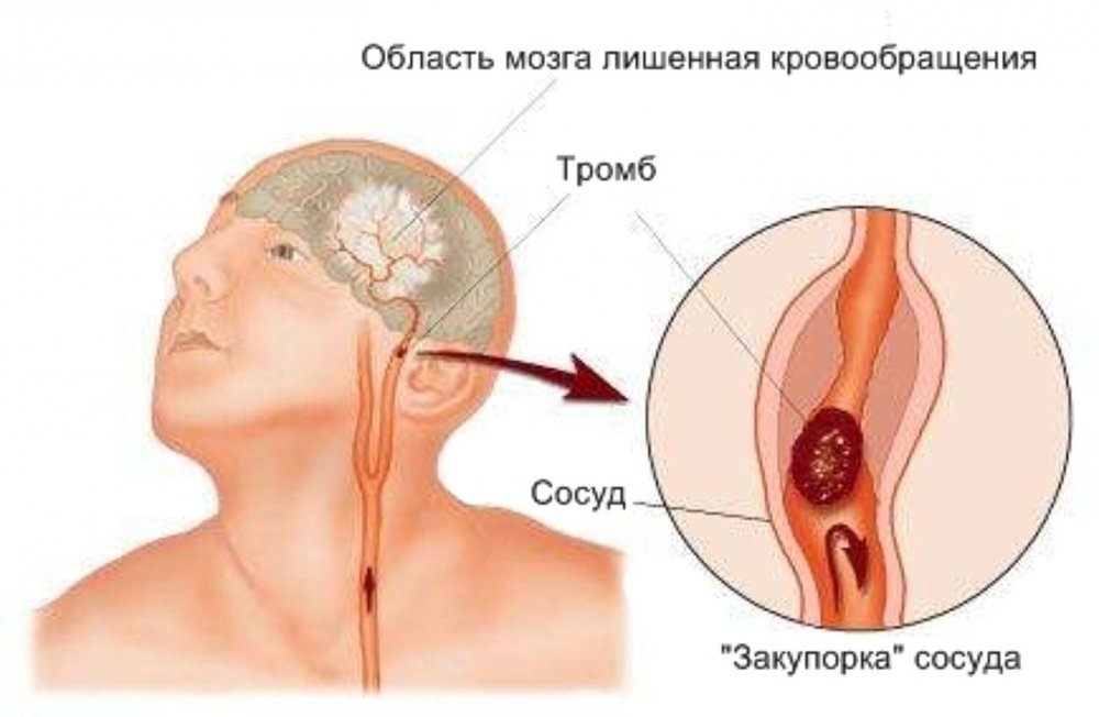 гадене, повръщане, главоболие - важна информация за удар-