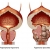 Симптоми на простатит и видове