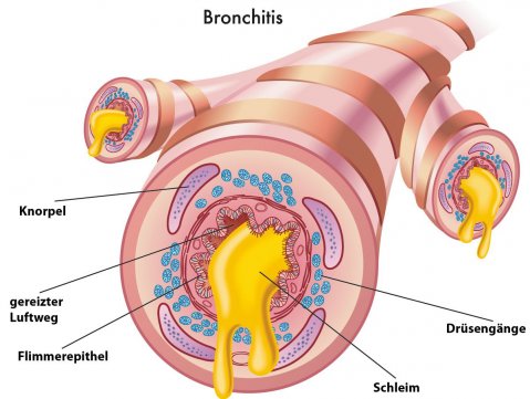 симптоми и причини за поява на бронхит