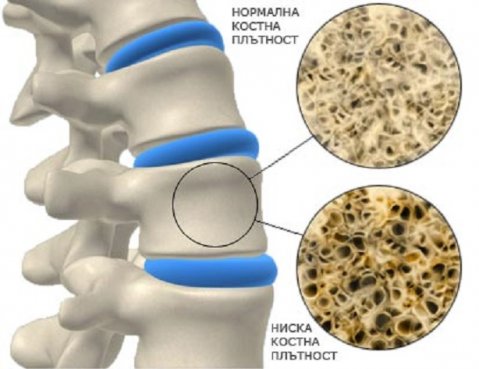 победете остеопорозата с правилно хранене-
