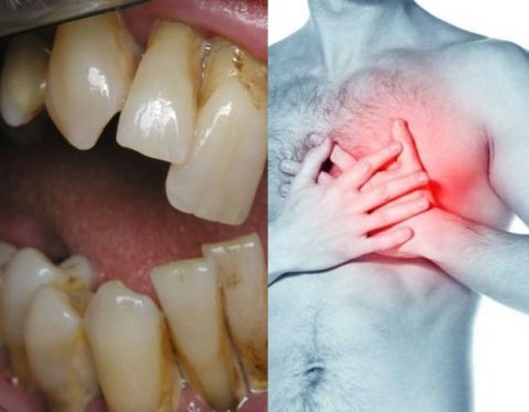 развалените зъби - голям риск от инфаркт