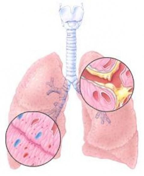 ето как да изчистите белите дробове за 3 дни