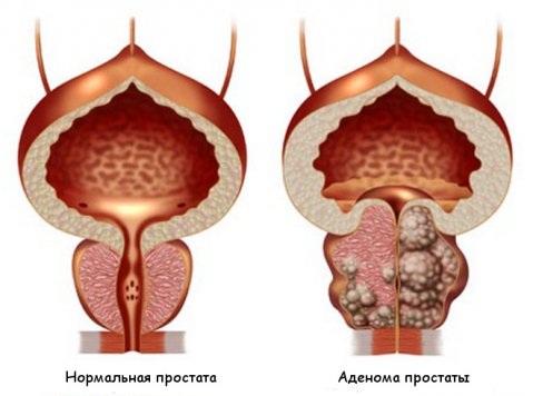 симптоми на простатит и видове