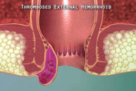 как да спрем кървенето, когато имаме хемороиди
