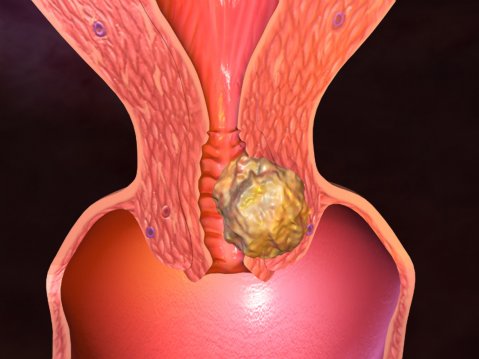 ракът на маточната шийка се лекува, ако забележите навреме тези симптоми
