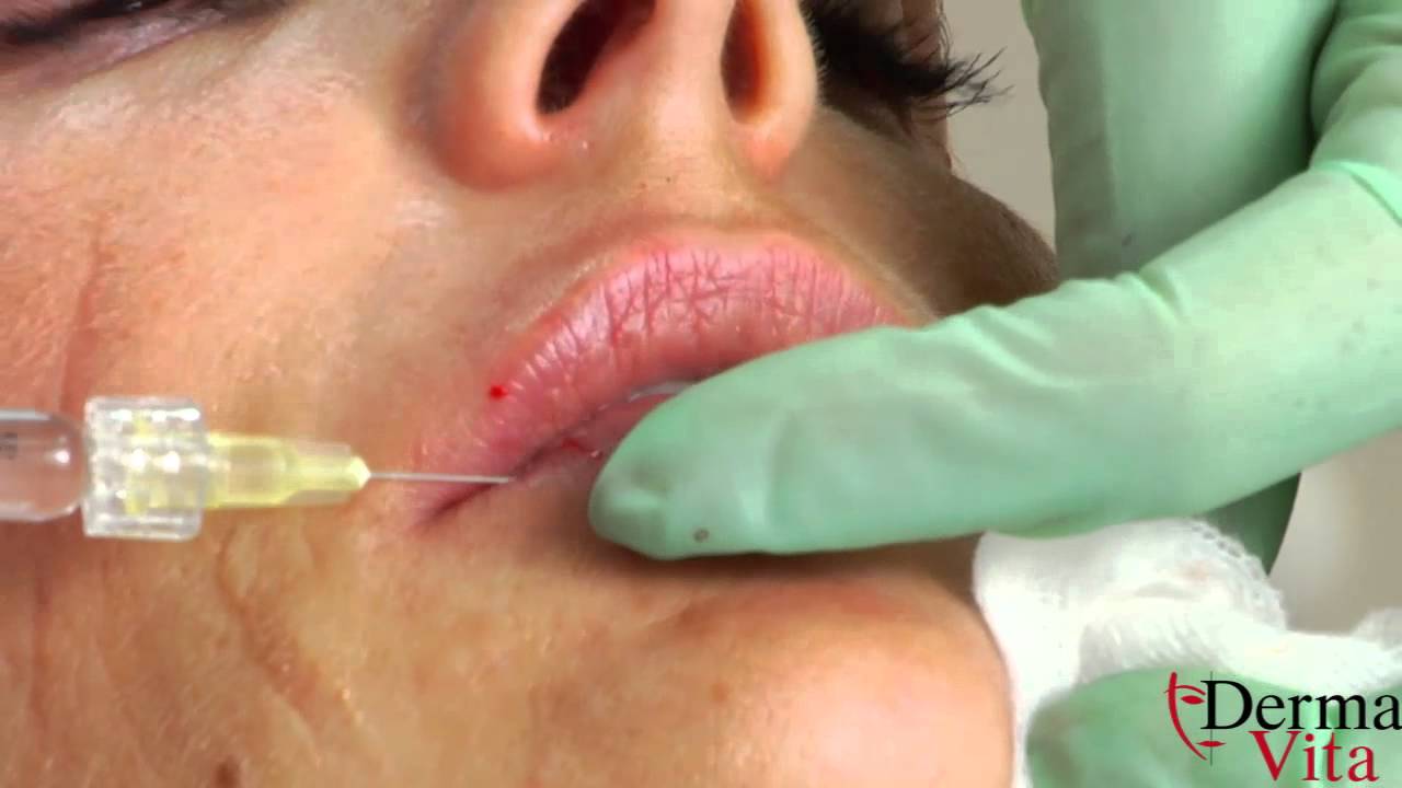 как се оформят устни с хиалуронова киселина